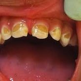 Bottle feeding caries